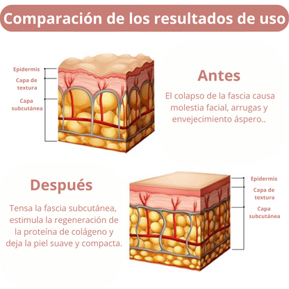 Máquina facial ultrasónica HiFU RF para reafirmar la piel