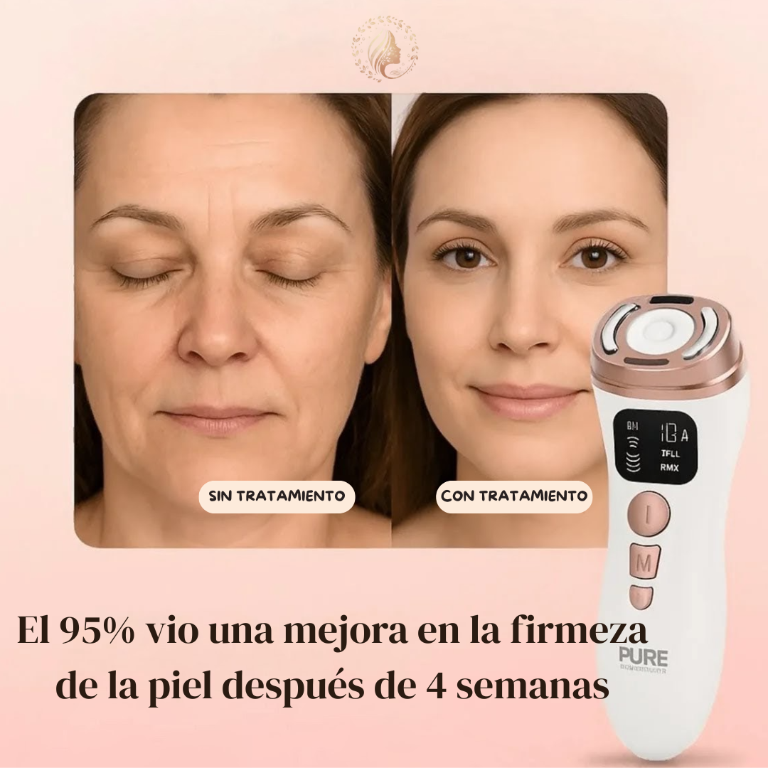 Máquina facial ultrasónica HiFU RF para reafirmar la piel